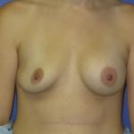 Breast Augmentation Before & After Patient #7493