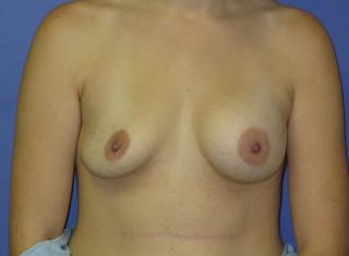 Breast Augmentation Before & After Patient #7493