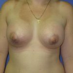 Breast Augmentation Before & After Patient #7488