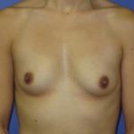 Breast Augmentation Before & After Patient #7528