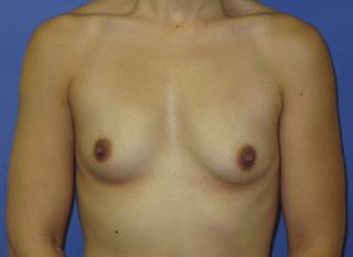 Breast Augmentation Before & After Patient #7528