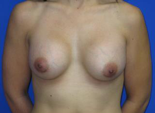 Breast Augmentation Before & After Patient #7528