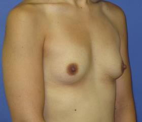 Breast Augmentation Before & After Patient #7528