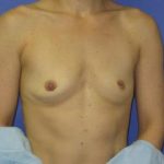 Breast Augmentation Before & After Patient #7533