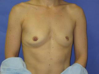 Breast Augmentation Before & After Patient #7533