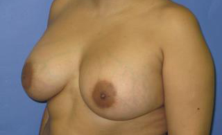 Breast Augmentation Before & After Patient #7539