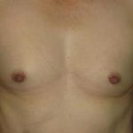 Breast Augmentation Before & After Patient #1196