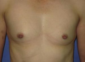 Breast Augmentation Before & After Patient #1196