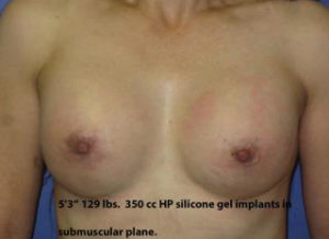 Breast Augmentation Before & After Patient #1196