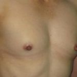 Breast Augmentation Before & After Patient #1196