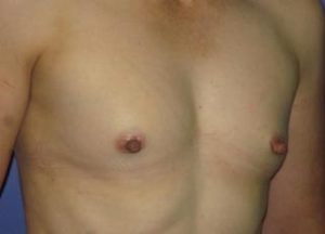 Breast Augmentation Before & After Patient #1196