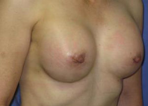 Breast Augmentation Before & After Patient #1196