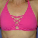 Breast Augmentation Before & After Patient #1201