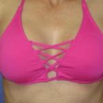Breast Augmentation Before & After Patient #1201