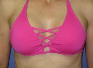 Breast Augmentation Before & After Patient #1201