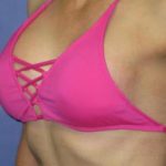 Breast Augmentation Before & After Patient #1201