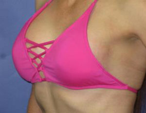 Breast Augmentation Before & After Patient #1201