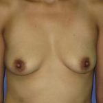 Breast Augmentation Before & After Patient #1206