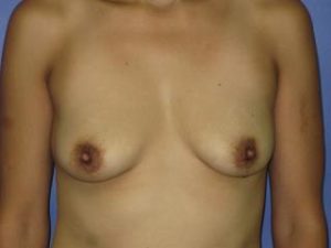 Breast Augmentation Before & After Patient #1206