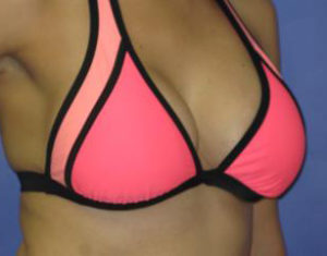 Breast Augmentation Before & After Patient #1213