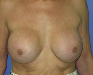 Breast Augmentation Before & After Patient #1219
