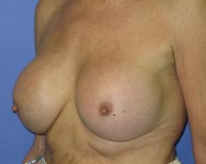 Breast Augmentation Before & After Patient #1219