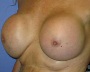 Breast Augmentation Before & After Patient #1219