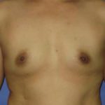 Breast Augmentation Before & After Patient #1226