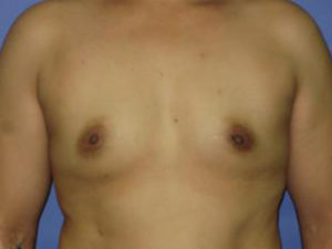 Breast Augmentation Before & After Patient #1226