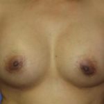 Breast Augmentation Before & After Patient #1226