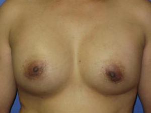 Breast Augmentation Before & After Patient #1226