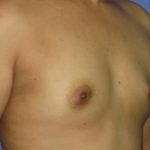 Breast Augmentation Before & After Patient #1226