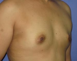 Breast Augmentation Before & After Patient #1226