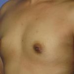 Breast Augmentation Before & After Patient #1226