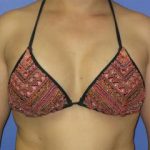 Breast Augmentation Before & After Patient #1233