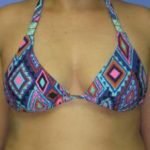 Breast Augmentation Before & After Patient #1243