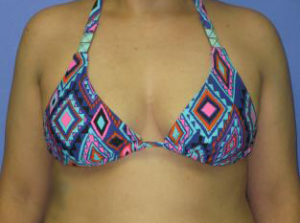 Breast Augmentation Before & After Patient #1243