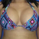 Breast Augmentation Before & After Patient #1243