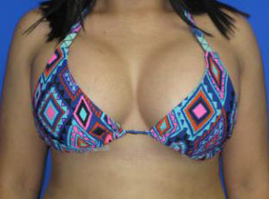 Breast Augmentation Before & After Patient #1243