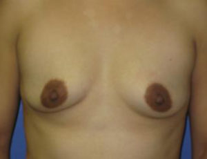 Breast Augmentation Before & After Patient #1248
