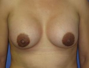 Breast Augmentation Before & After Patient #1248