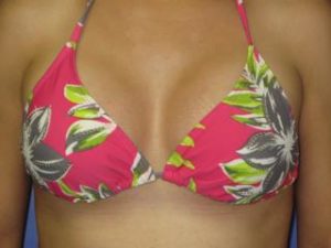 Breast Augmentation Before & After Patient #1255