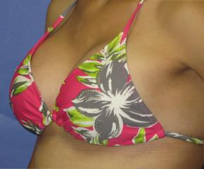 Breast Augmentation Before & After Patient #1255