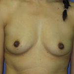 Breast Augmentation Before & After Patient #1260