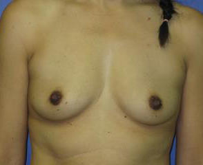 Breast Augmentation Before & After Patient #1260