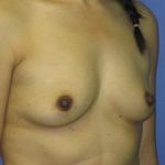 Breast Augmentation Before & After Patient #1260
