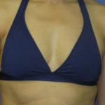 Breast Augmentation Before & After Patient #1267