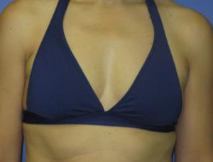 Breast Augmentation Before & After Patient #1267