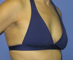 Breast Augmentation Before & After Patient #1267