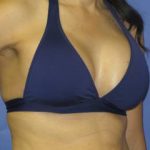 Breast Augmentation Before & After Patient #1267